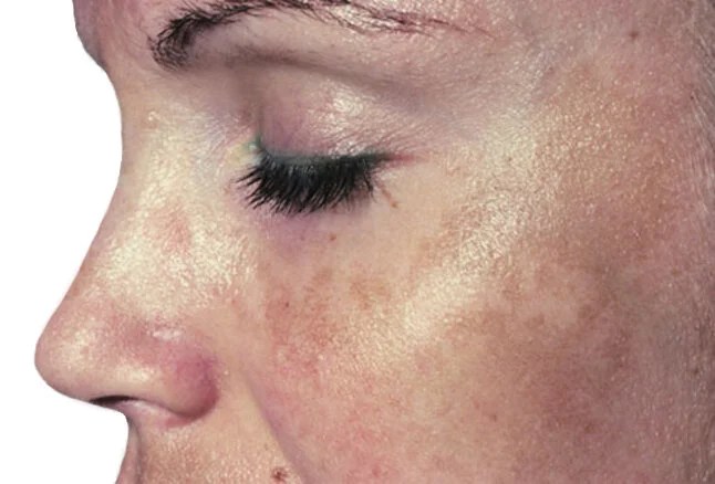 yuzning xiralashishiga nima sabab boladi 68bc56e406d46