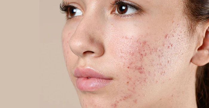 yuzning yoglanishi asosiy sabablar va yashirin omillar 68bc56d5ab7ec