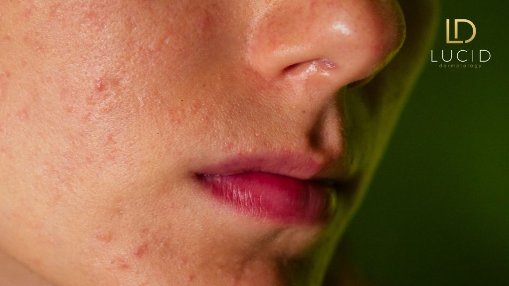 yuzning yoglanishi asosiy sabablar va yashirin omillar 68bc56d687004