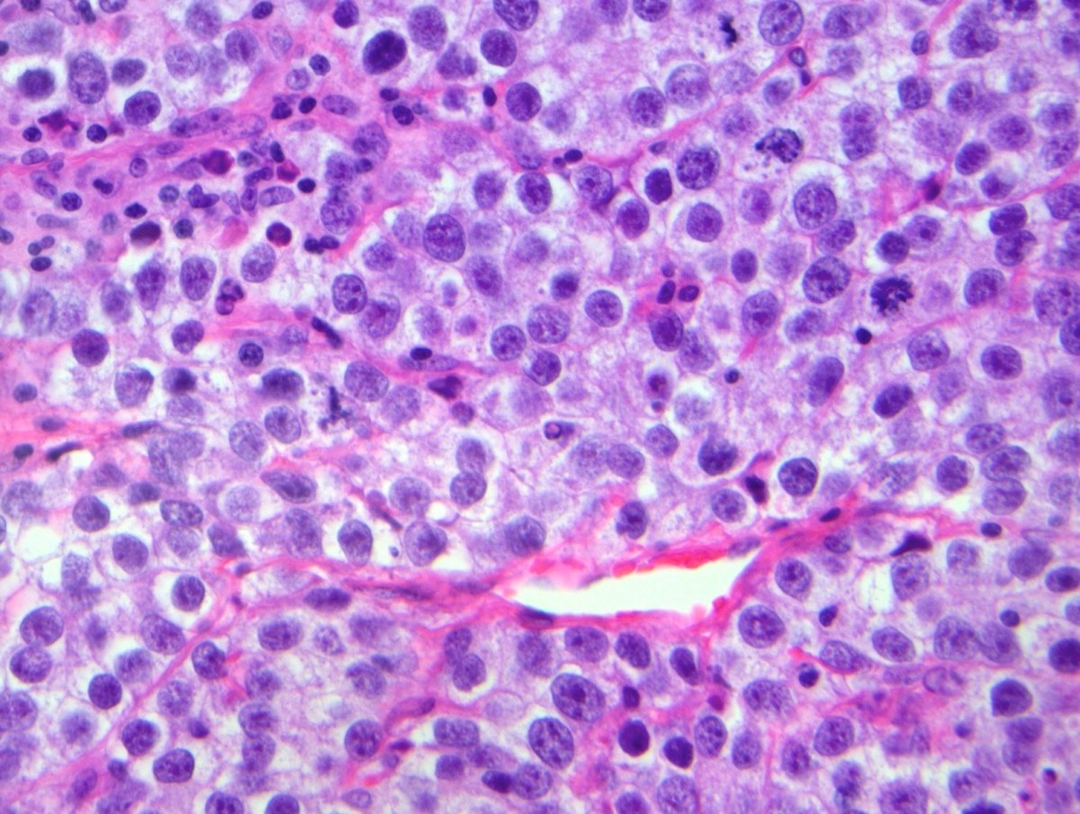disgerminoma nima va uning turlari 68f658d59c963