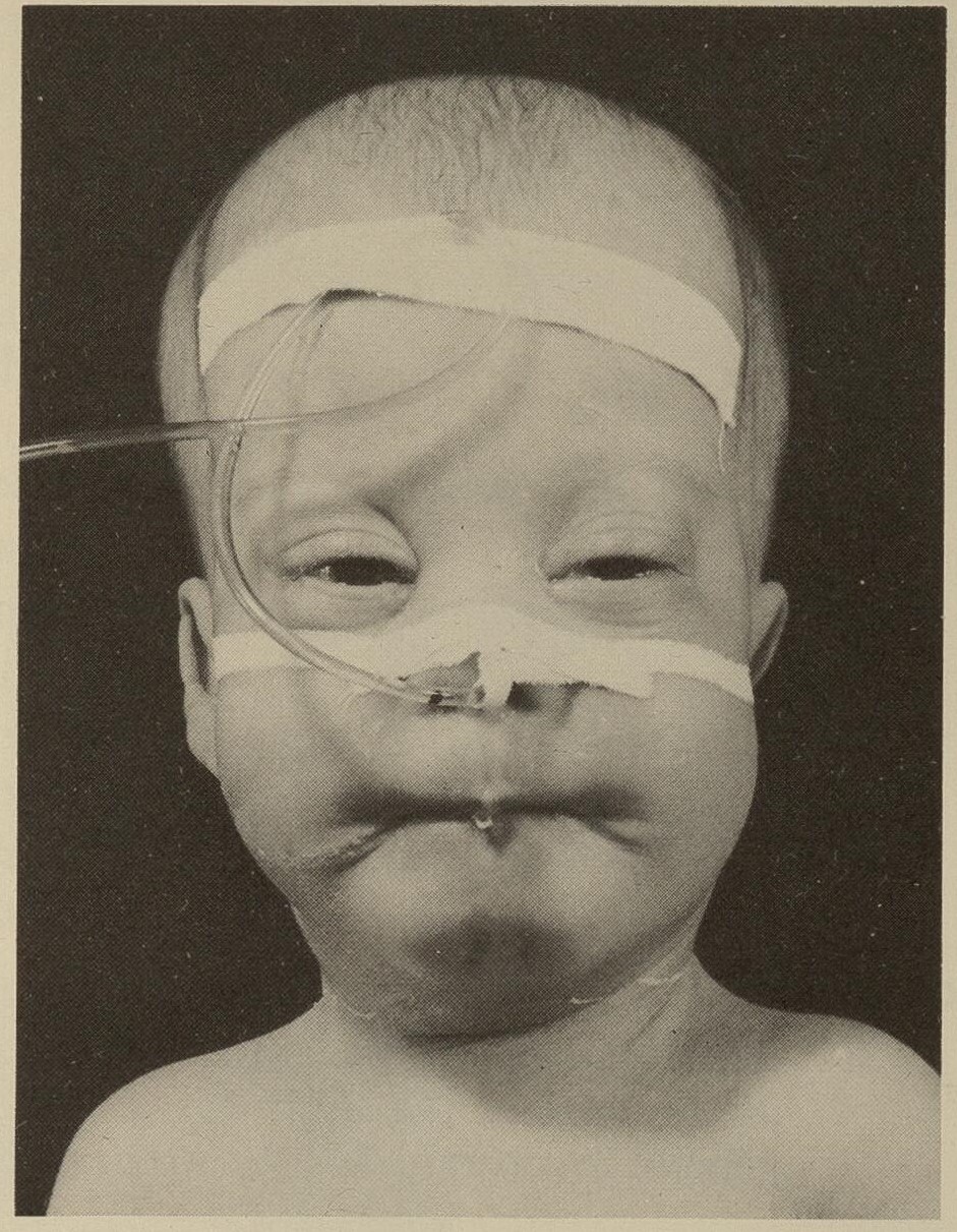 zellveger sindromi nima zellveger sindromi belgilari 690387f793d9e