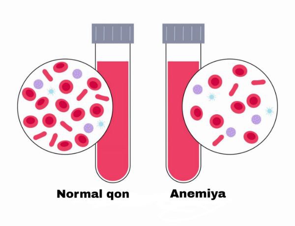 Gemoglobin (HGB) nima? 3 Homiladorlik davrida anemiya yoki kamqonlik nima