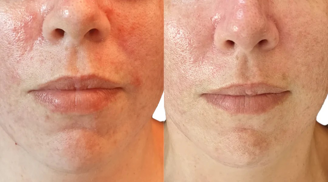 Dermapen nima? Dermapen nima uchun ishlatiladi? 3 dermapen nima dermapen nima uchun ishlatiladi 6942d00f2d167