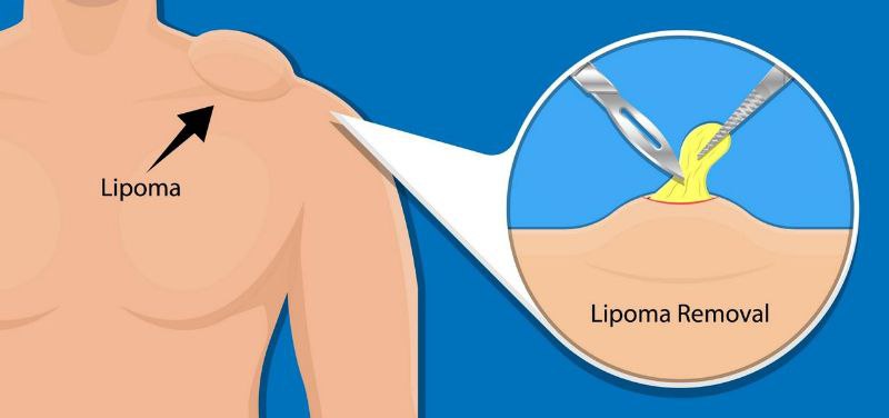 lipoma yog bezi nima 6944216d0a034