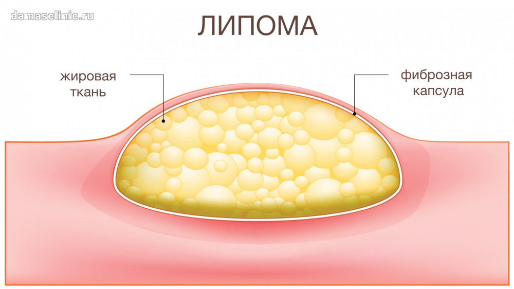lipoma yog bezi nima 6944216dda719