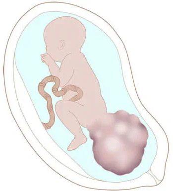 teratoma nima teratoma belgilari va sabablari 692db7d7ad969