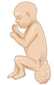 teratoma nima teratoma belgilari va sabablari 692db7d7f13d0