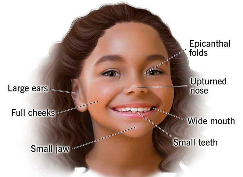 uilyams sindromi nima uilyams sindromi belgilari qanday 69305ad6c6c6a