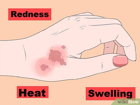 yogda kuyish yogda kuyishi qanday davolanadi 694572d68bf21