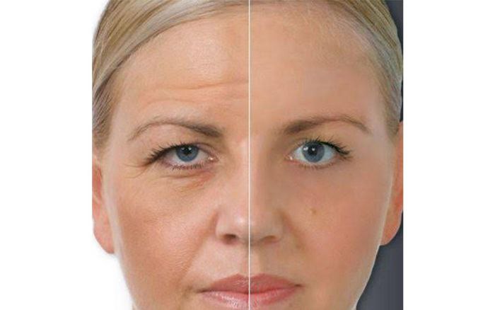 Teri osilishini yo‘qotish bo‘yicha jarrohlik amaliyoti