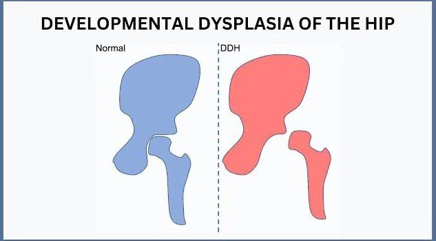 displaziya nima yengil displaziya nima 695fd0d72ee15
